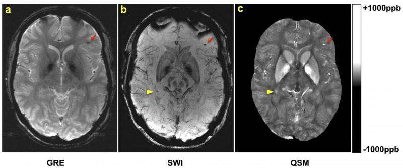 La Risonanza magnetica (MRI) migliora la diagnosi nellindividuazione delle microemorragie dopo un trauma cranico